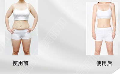 广州美丽加,5D精雕仪,面部美容,身体拨罐,除脂美体瘦腰效果对比图