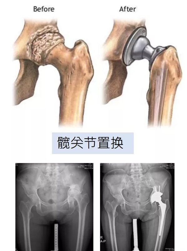 台湾人工关节置换术 台湾人工关节置换术