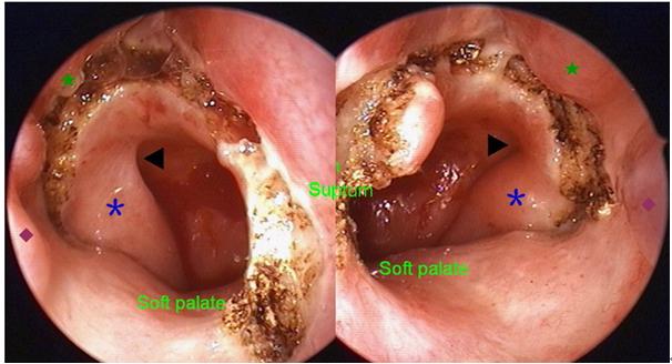 鼻咽癌台湾长庚医院 鼻咽癌台湾长庚医院