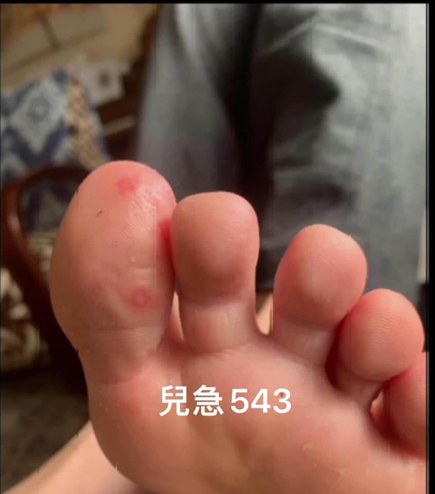 儿童无症状感染