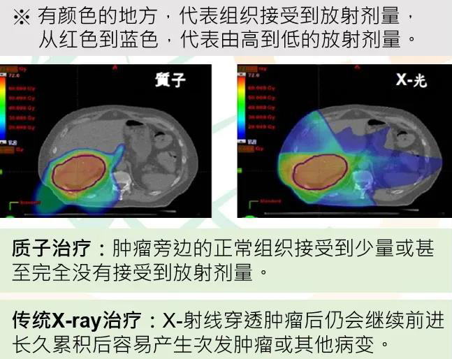 台湾长庚医院肝癌的质子治疗