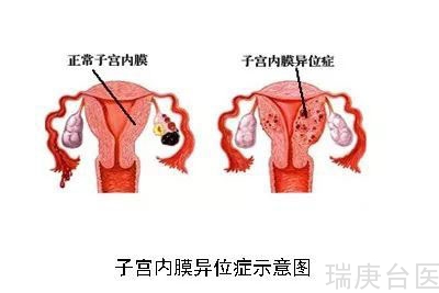 臺灣長庚醫院 | 罕見子宮角異位懷孕 選擇性減胎母子平安