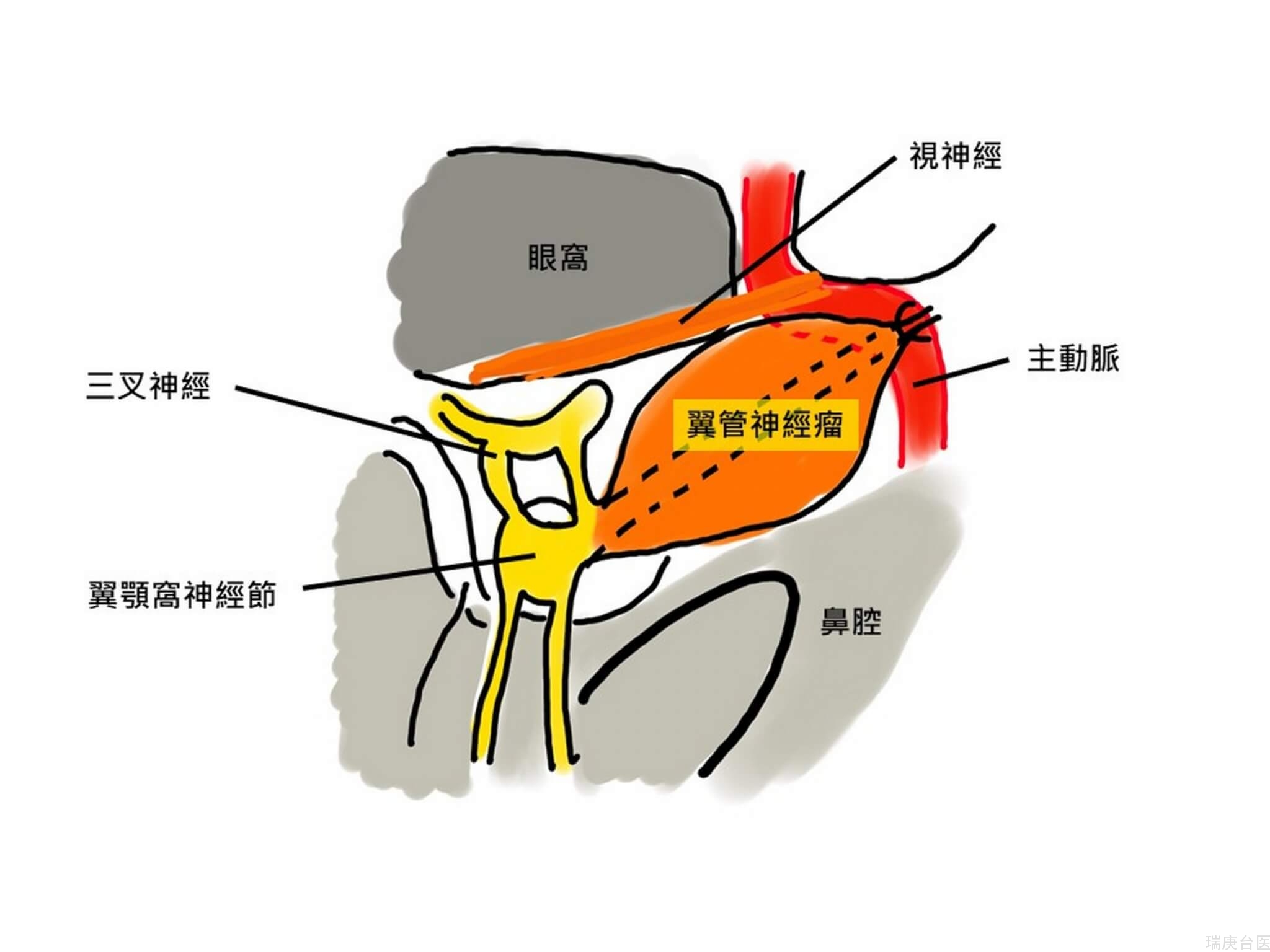 台湾首例！鼻水狂流原来是全球不到20例的罕见神经瘤