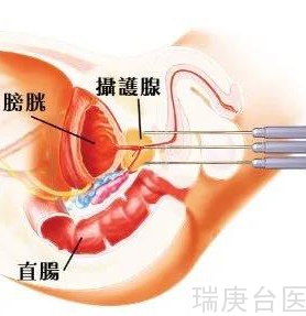 【台湾长庚医院】守护男性生命腺： 谈「海扶刀」及「冷冻疗法」在前列腺癌的应用