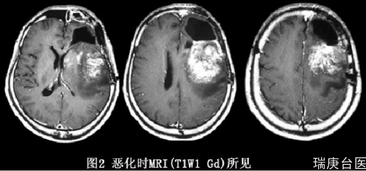 BNCT案例 | 胶质瘤术后复发硼中子捕获治疗