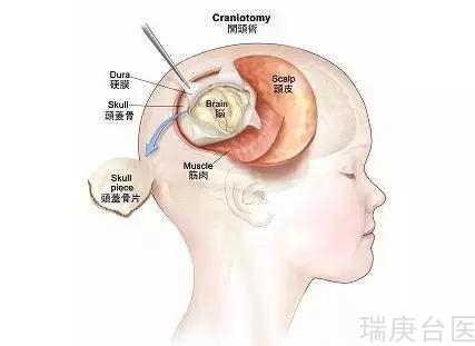 BNCT | 硼中子俘获疗法是目前治疗胶质瘤的<span style=