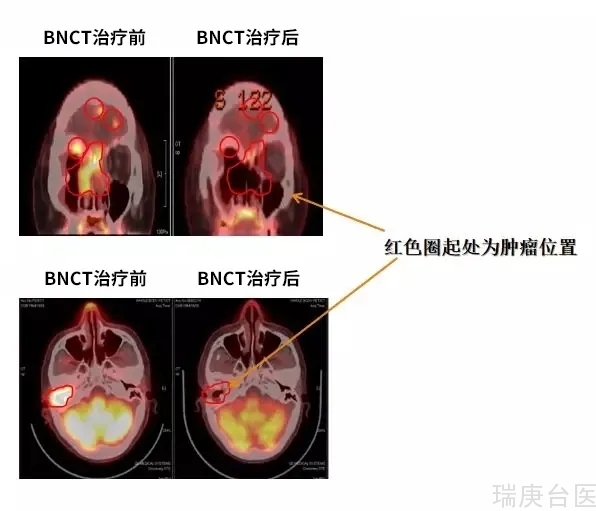 BNCT | 接受硼中子治疗的患者怎么样了？