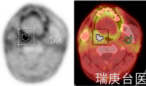 台湾BNCT | 正子摄影在硼中子捕获治疗所扮演的角色及应用