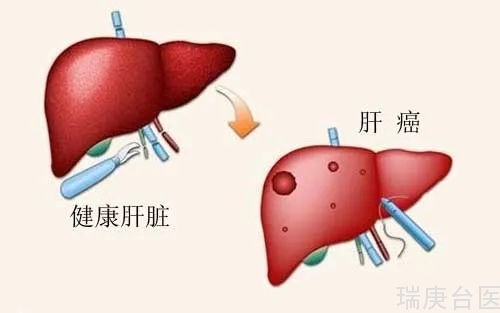 台湾长庚医院 | 治肝癌不损及肝脏 研究找到解方