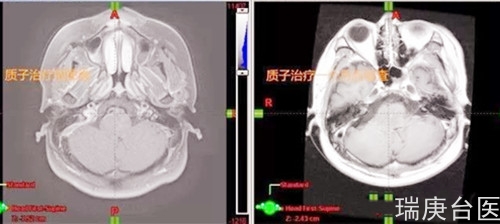 案例分享 | 质子治疗脑干胶质瘤的效果