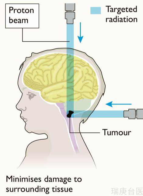 质子治疗脑膜瘤 | 肿瘤持续缩小，3年多无复发，无副作用，认知发育正常