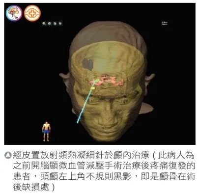 【台湾长庚医院】助三叉神经痛病人远离疼痛-计算机断层实时导航系统准确定位