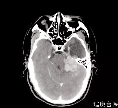 案例分享 | 血管周细胞瘤复发，质子治疗肿瘤较治疗前明显缩小