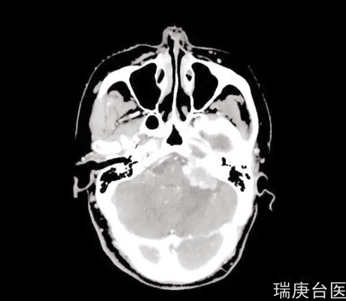 案例分享 | 血管周细胞瘤复发，质子治疗肿瘤较治疗前明显缩小