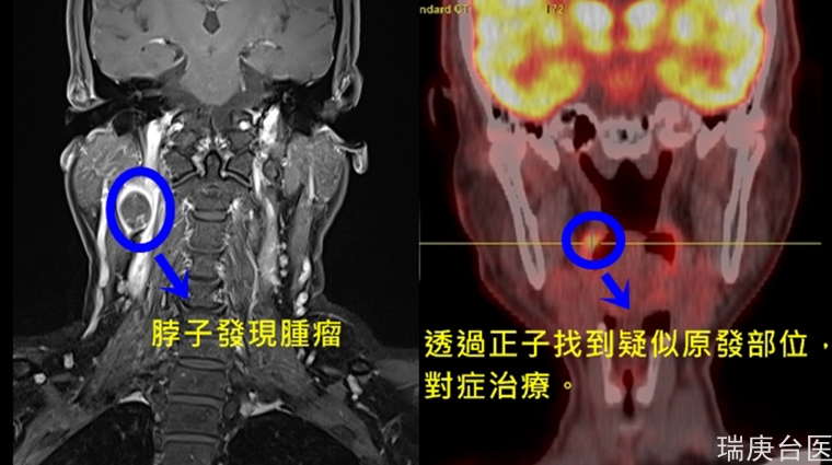 揪出原发部位不明转移癌 不让癌症捉迷藏