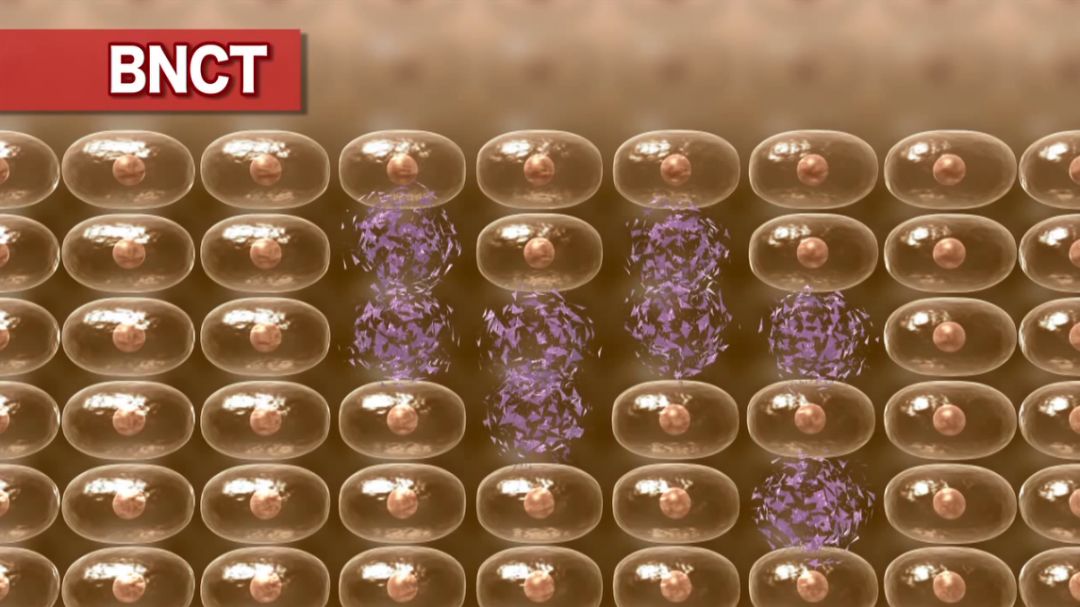 BNCT | 硼中子俘獲療法可以治療肝癌嗎？