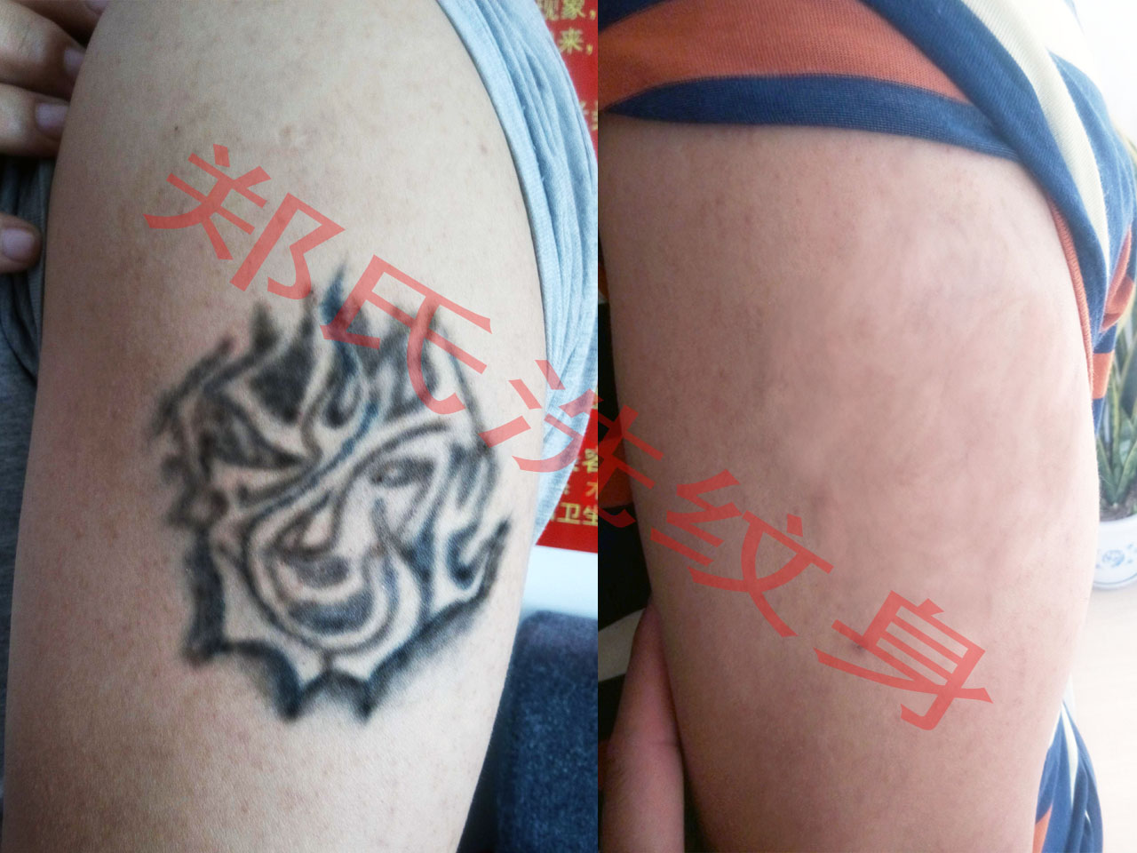 盘锦洗纹身