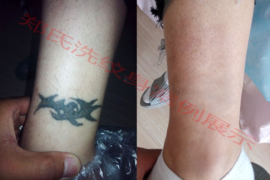 洗纹身案例49